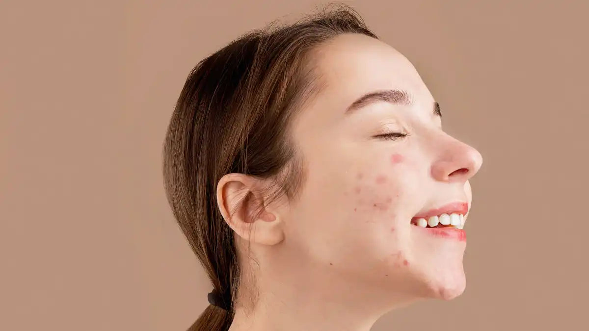 Acneea: mituri și adevăruri: ghidul complet pentru o îngrijire corectă