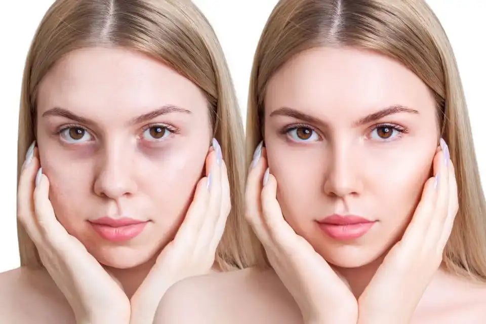 Cum scapi de cearcăne? 5 sfaturi și metode recomandate